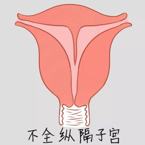 双子宫,子宫异常,不孕,生殖健康