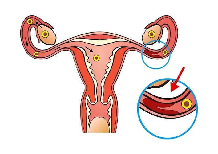 输卵管堵塞,排卵,生育,卵巢功能,不孕症
